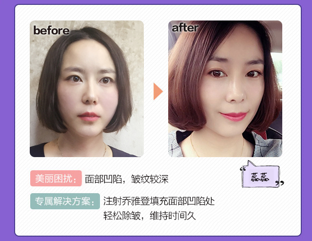 乔雅登玻尿酸_长沙艺星医疗美容医院